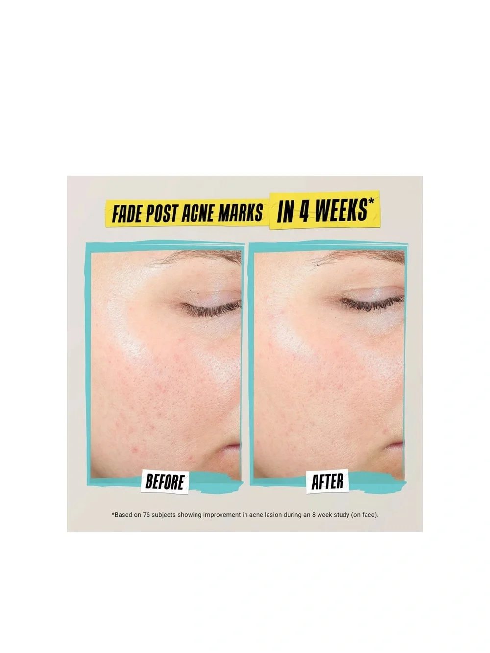 Kiehl's Expertly Clear Acne-Treating & Preventing Lotion $39